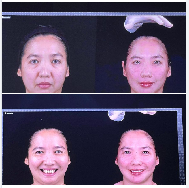 CÓ THỂ XÓA BỎ NỌNG CẰM VỚI FILLER MD CODES, BẠN CÓ TIN KHÔNG?