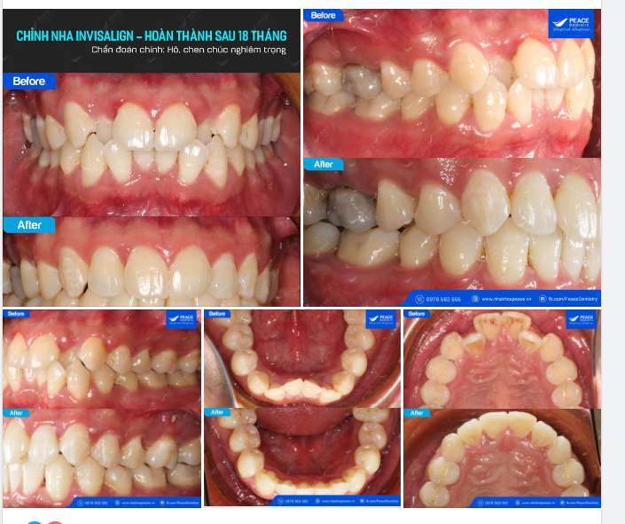 Dù là niềng răng mắc cài truyền thống hay niềng răng vô hình bằng khay trong suốt Invisalign ứng dụng công nghệ hiện đại và tiên tiến