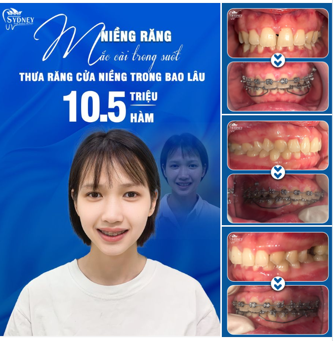 THƯA RĂNG CỬA NIỀNG TRONG BAO LÂU?
