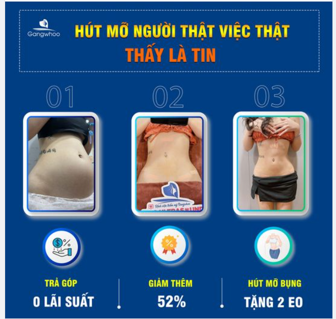 ĐI HÚT MỠ - HÃY XEM NGƯỜI THẬT VIỆC THẬT!