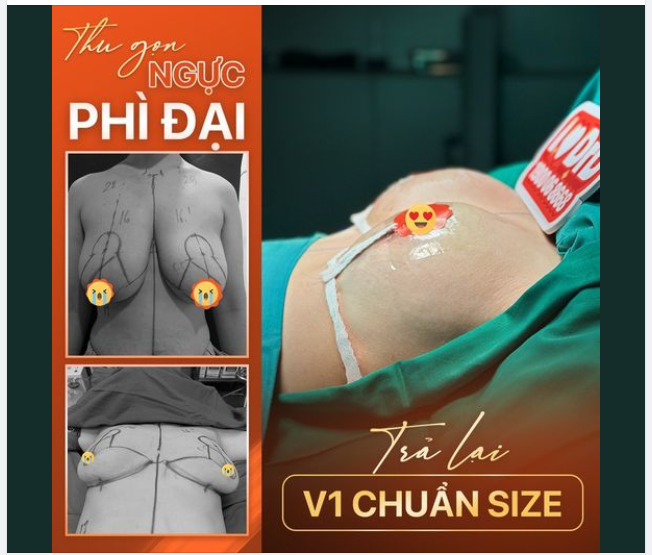 NHỮNG NỖI KHỔ MANG TÊN "NGỰC PHÌ ĐẠI"