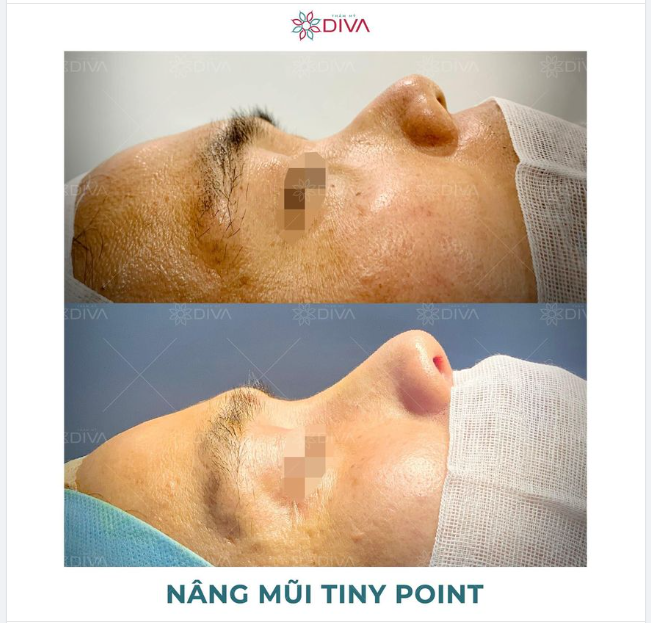 KẾT QUẢ THẨM MỸ SAU 5 PHÚT NÂNG MŨI KẾT QUẢ RA SAO?
