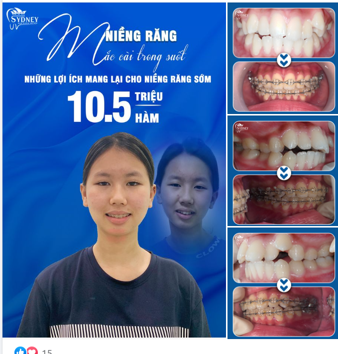 LỢI ÍCH CỦA NIỀNG RĂNG CHO RĂNG ĐỀU ĐẸP, CHẮC KHỎE
