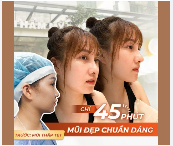 Góc nghiêng kém xinh, không cần làm gì nhiều, chỉ cần Nâng mũi là đủ.