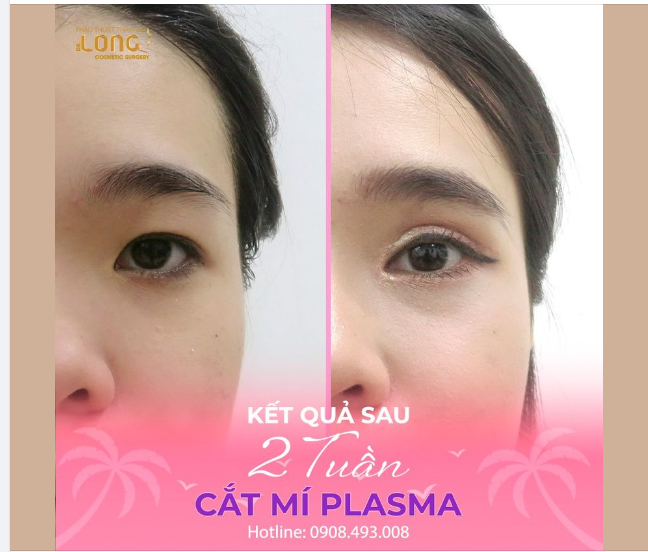 HÈ RỰC RỠ - MẮT ĐẸP HẾT CỠ  Với kết quả sau 30 phút thu hút ánh nhìn