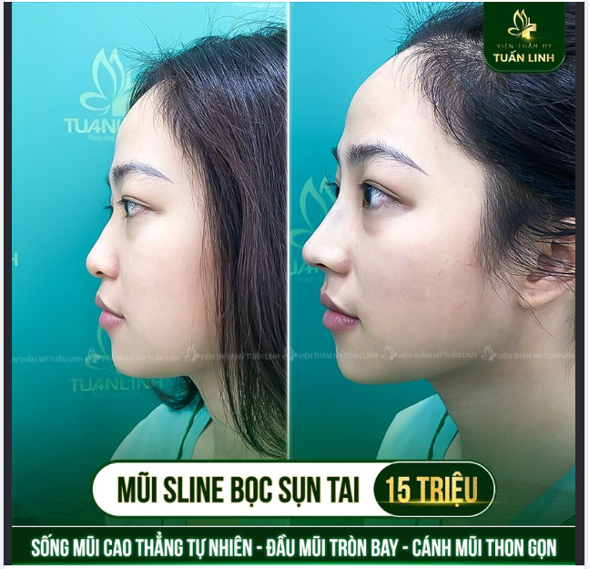 Nâng cấp chiếc mũi với giá15triệu đẹp xuất sắc sau 90 phút