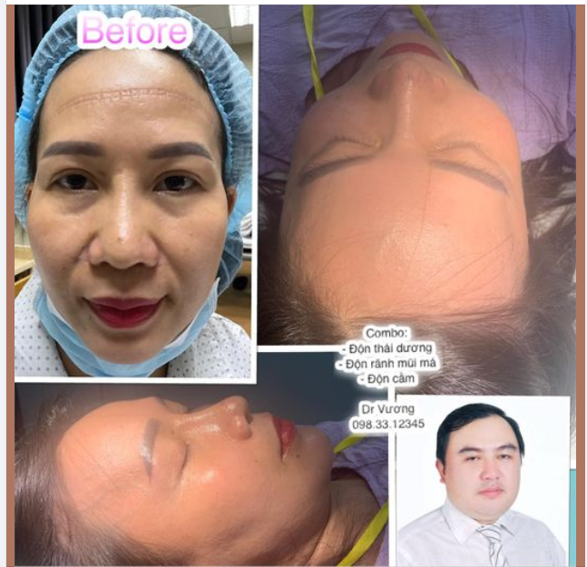 Siêu combo về làm đầy vùng lõm sâu cho cô giáo đến từ Mỹ Đình với Dr Vương, nay đến cắt chỉ: