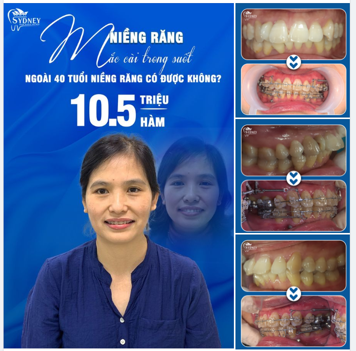 NGOÀI 40 TUỔI CÓ NIỀNG ĐƯỢC KHÔNG?