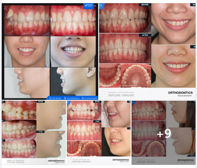 NIỀNG RĂNG LÀ ĐỂ ĐẸP HƠN