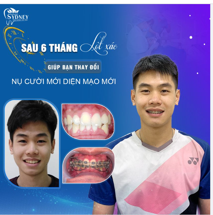 LỢI ÍCH MANG LẠI KHI CÓ KHỚP CẮN CHUẨN