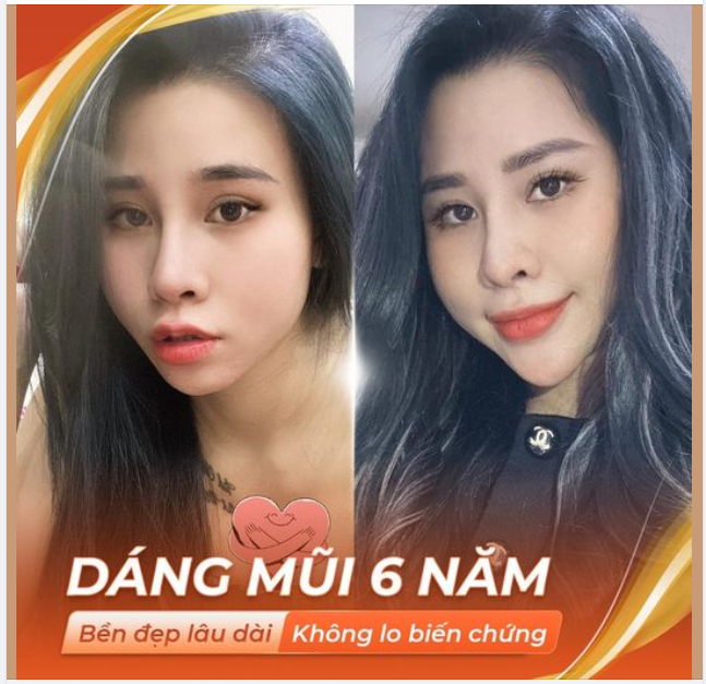 NÂNG MŨI 1 LẦN - ĐẸP TRỌN ĐỜI