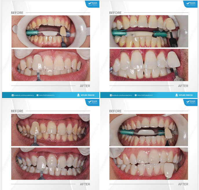 Tẩy trắng răng là dịch vụ được ưa chuộng bởi những khách hàng mong muốn có một nụ cười rạng rỡ, trắng sáng vượt trội, loại bỏ mọi vết ố màu mà chi phí tiết kiệm.