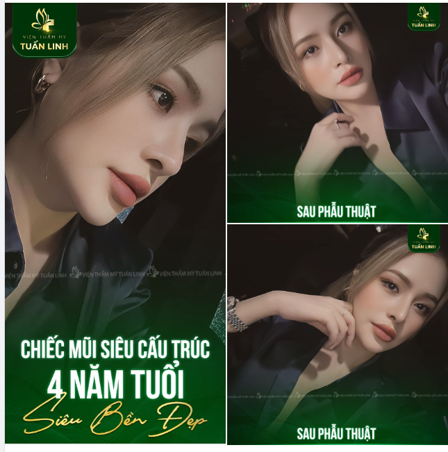 MŨI BỀN ĐẸP GỌI TÊN TUẤN LINH