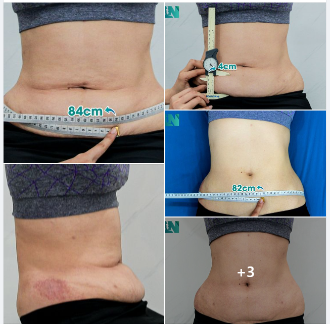 HÚT MỠ TẠO DÁNG THẨM MỸ CHO CHỊ KH 9X: TIN TƯỞNG LỰA CHỌN GIẢM MỠ TẠI EKIP BÁC SĨ LƯƠNG NGỌC VÌ ĐƯỢC NGƯỜI THÂN GIỚI THIỆU. TRỰC TIẾP VÀO 16H00 HÔM NAY