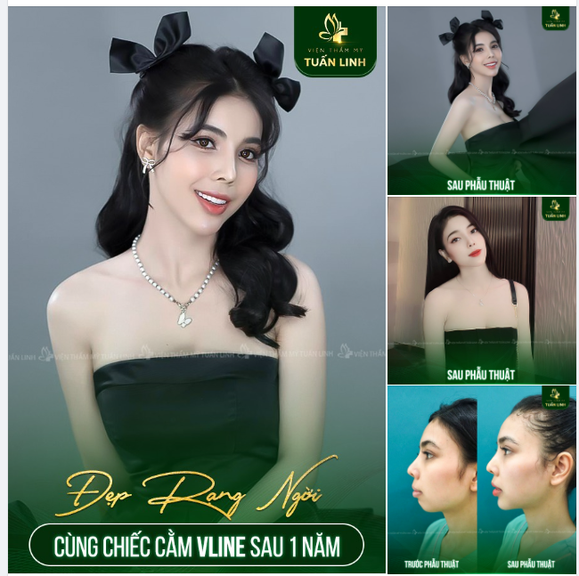 ĐẸP SANG CHẢNH CÙNG CHIẾC CẰM V LINE THỜI THƯỢNG 