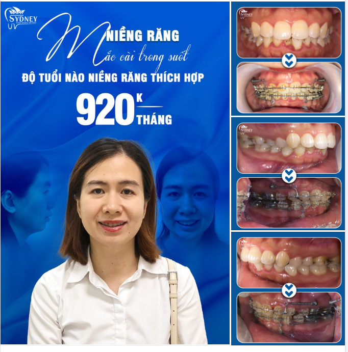 ĐỘ TUỔI THÍCH HỢP ĐỂ NIỀNG RĂNG?
