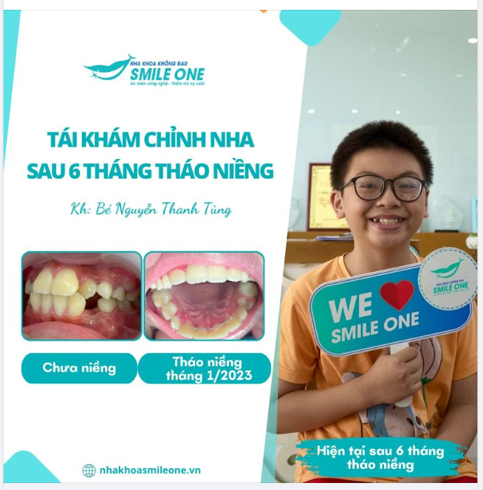 Bạn thắc mắc sau tháo niềng, răng có chạy lại không?