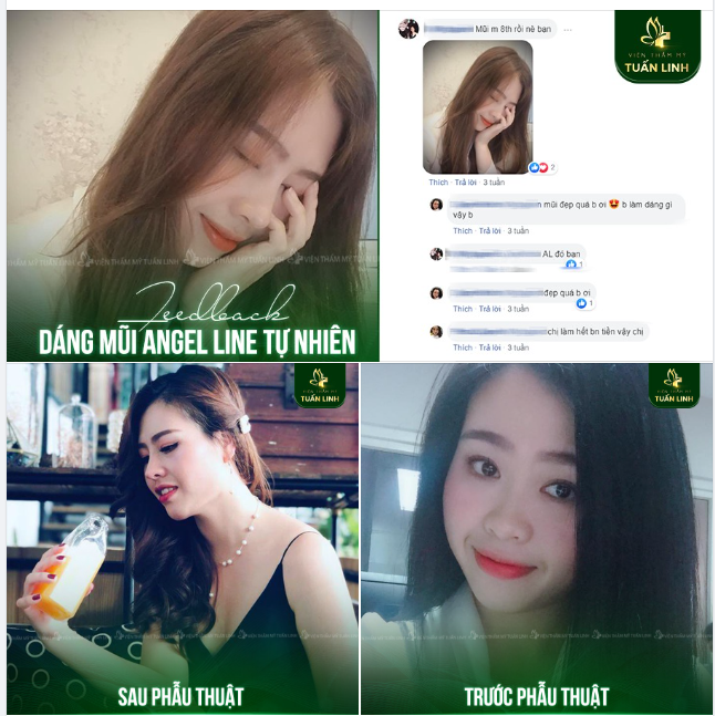 Dáng mũi Angel line tự nhiên - Đẹp thanh tú mọi góc nhìn!!