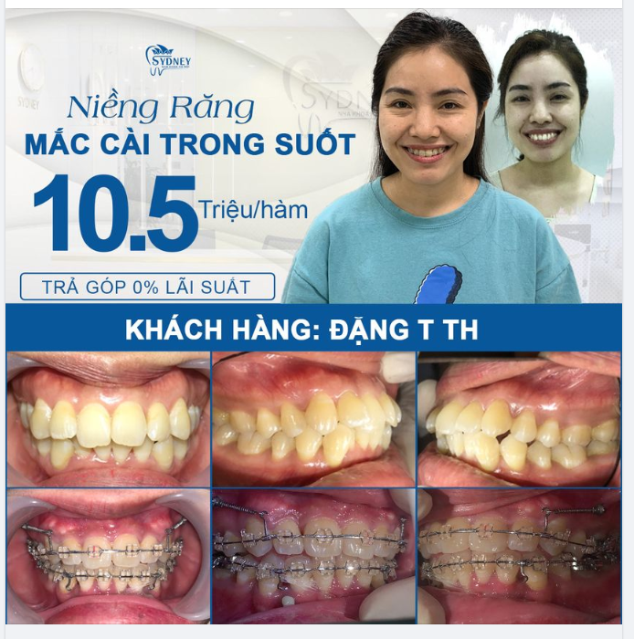 NIỀNG RĂNG HÔ MẤT NHIỀU THỜI GIAN HƠN SO VỚI RĂNG KHẤP KHỂNH, RĂNG THƯA,..?