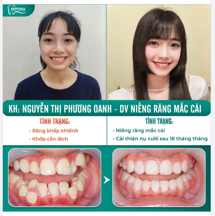 VẺ ĐẸP MỚI: NIỀNG RĂNG KHIẾN TÔI TRỞ NÊN NỔI BẬT”
