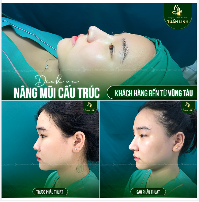 Dáng mũi dành cho những bạn có gương mặt tròn bầu bĩnh, dễ thương nhưng thích sự sắc nét đây ạ.