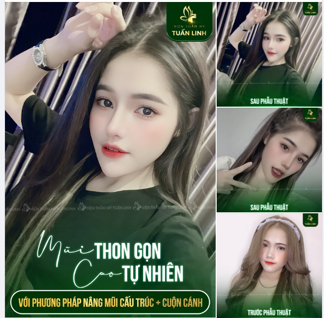 Nâng mũi cấu trúc + cuộn cánh Giải pháp hoàn hảo cho dáng mũi cao thon gọn, đẹp tự nhiên.