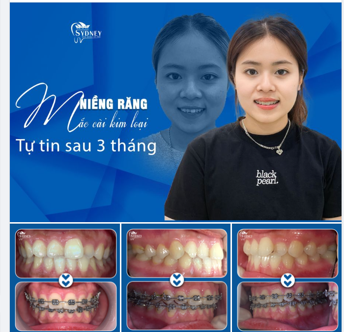 PHẢI LÀM SAO KHI RĂNG CỬA MỌC LỆCH?