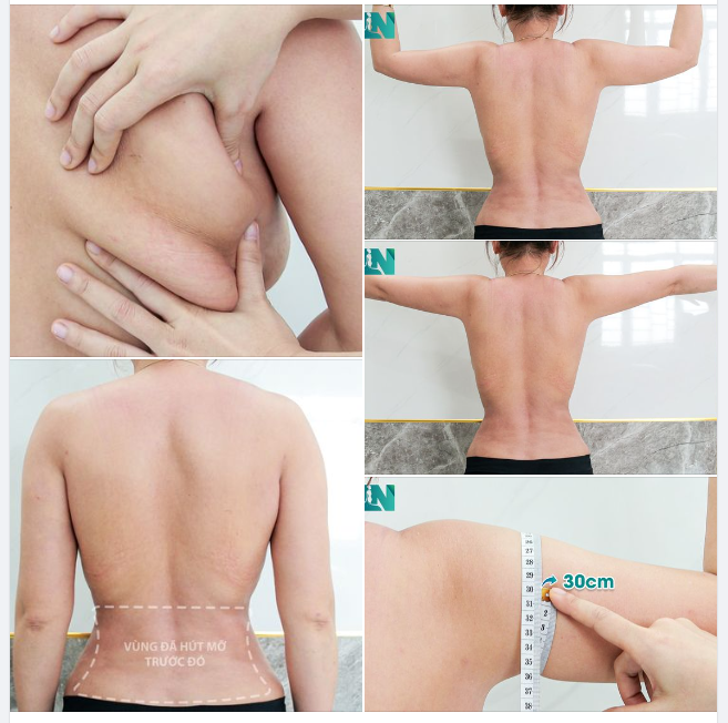 ĐỢT 2: HÚT MỠ TẠO DÁNG THẨM MỸ CÁC VÙNG: TAY, LƯNG, NÁCH CHO CHỊ KH 8X ĐẾN TỪ BÌNH PHƯỚC. ĐÃ HÚT MỠ BỤNG TẠI EKIP HƠN 1 NĂM TRƯỚC. TRỰC TIẾP 15H00 HÔM NAY