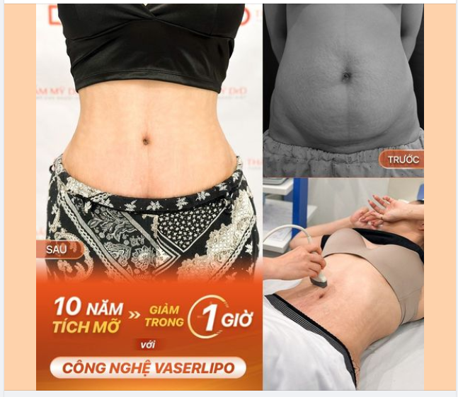 10 NĂM TÍCH MỠ, GIẢM TRONG 1 GIỜ