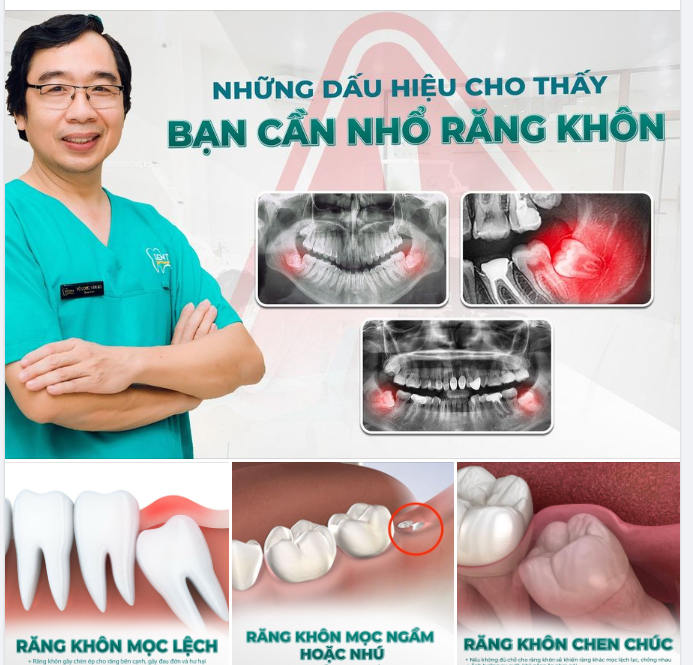 NHỮNG DẤU HIỆU CHO THẤY BẠN CẦN NHỔ RĂNG KHÔN