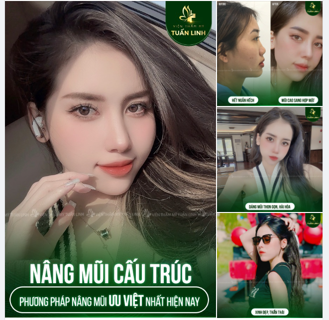 MŨI CAO CÂN ĐỐI – ĐẸP TỰ NHIÊN – CHUẨN NHÂN TRẮC HỌC