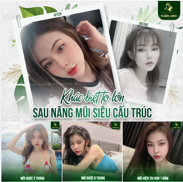 Khác biệt to lớn và hành trình nâng mũi siêu cấu trúc của Hotgirl 9x 