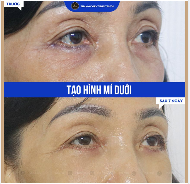 XÓA TAN BỌNG MỠ MÍ DƯỚI - CHỈ 30 PHÚT