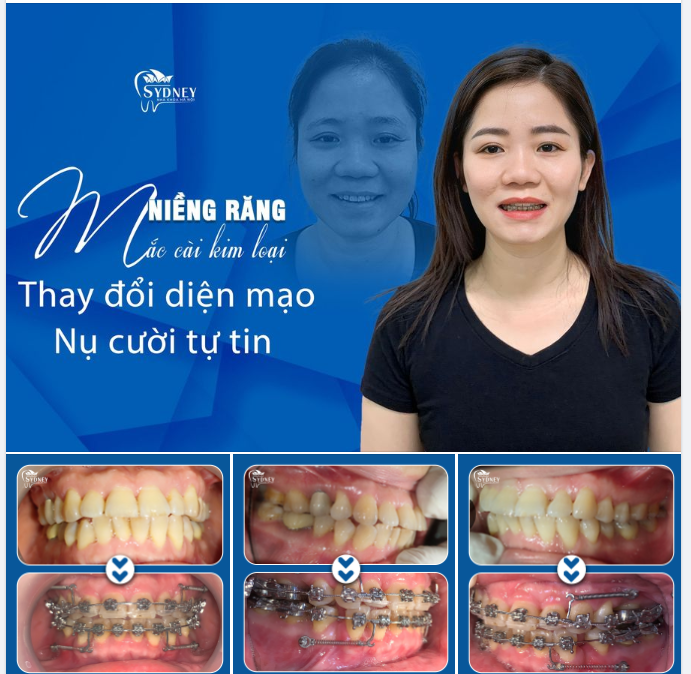 CƯỜI TƯƠI DUYÊN DÁNG VỚI MẮC CÀI NIỀNG RĂNG️