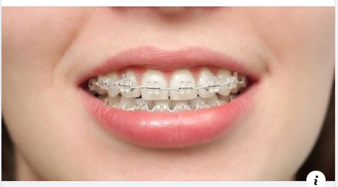 Tại sao mùa hè là thời điểm lý tưởng để CHỈNH NHA?