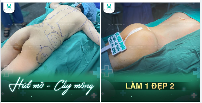 Cấy m.ỡ tạo hình mông | Nhanh chóng - An toàn - Đẹp tự nhiên - Không cần dùng vật liệu độn.