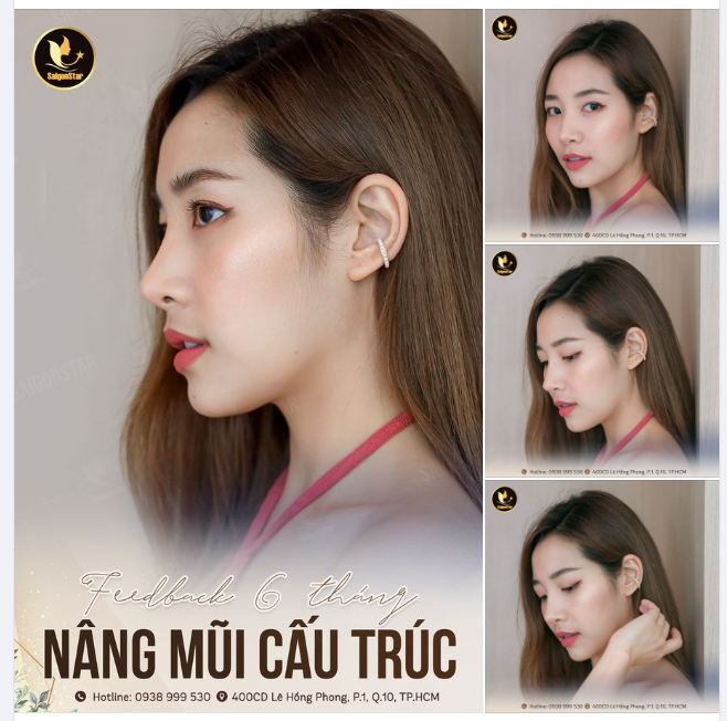 KHOE NHẸ MỘT KHÁCH XINH SAU 6 THÁNG NÂNG MŨI CẤU TRÚC DR. HOẠT