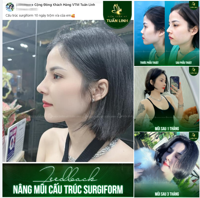 Nâng ngực tại Tuấn Linh cách đây 1 năm và lần này bạn vẫn chọn Tuấn Linh để nâng mũi + nhấn mí để xinh đẹp hơn nữa.