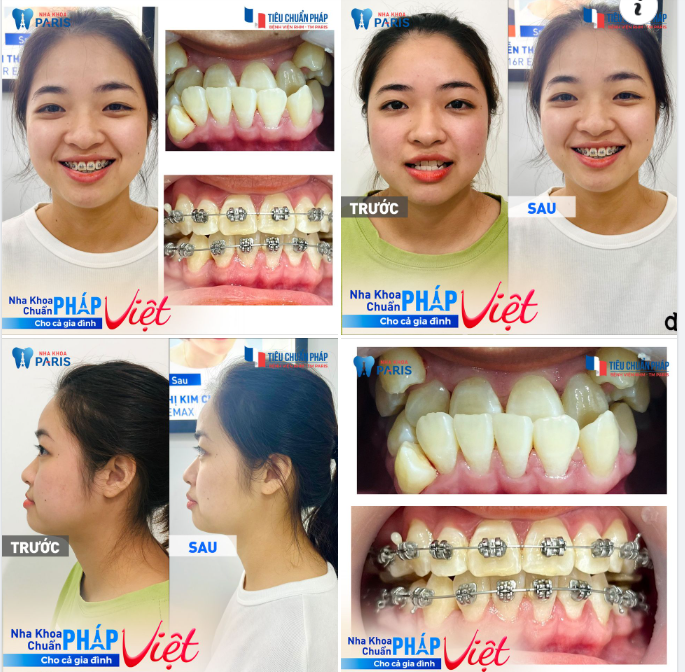 Niềng răng mắc cài tự buộc 3M