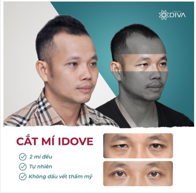 CẮT MÍ MẮT – MẮT 2 MÍ ĐỀU ĐẸP THU HÚT