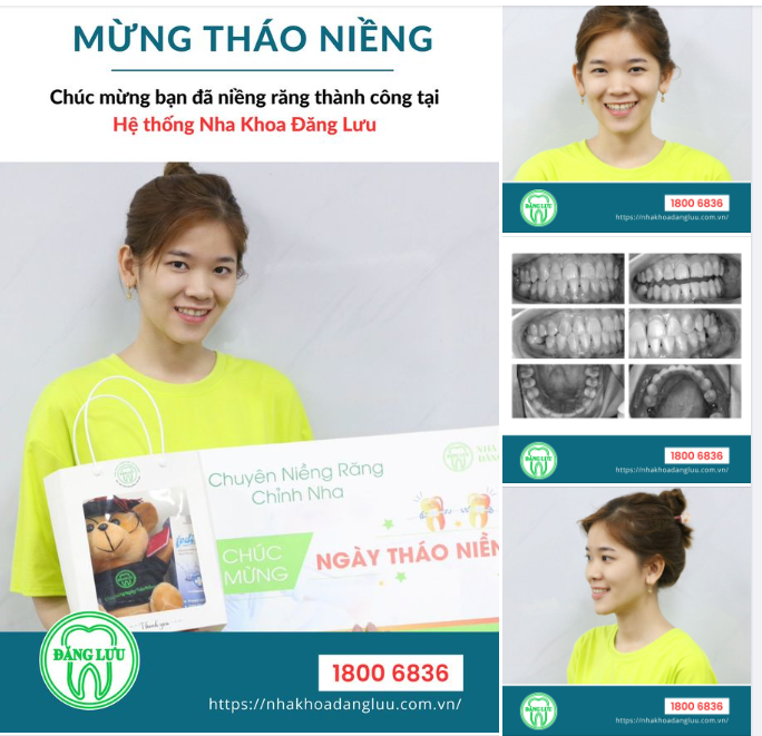 Nha Khoa Đăng Lưu chúc bạn luôn xinh đẹp, rạng rỡ, hạnh phúc và thành công hơn với nụ cười mới này bạn nhé!