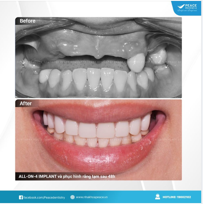 KHÔNG HÀI LÒNG VỚI HÀM THÁO LẮP ​​​​​​​ ALL-ON-4 IMPLANT LÀ GIẢI PHÁP THAY THẾ THUYẾT PHỤC HOÀN TOÀN