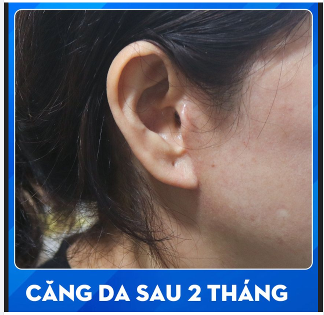 CẬN CẢNH CĂNG DA KHÔNG SẸO SAU 2 THÁNG