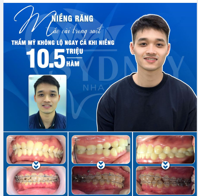 THỜI ĐIỂM NIỀNG RĂNG GIÁ TỐT NHẤT NĂM