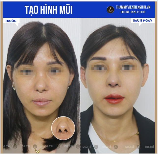 HÀNG TRĂM CA MŨI KHÓ ĐÃ ĐƯỢC DR TRÍ TẠO HÌNH THÀNH CÔNG!