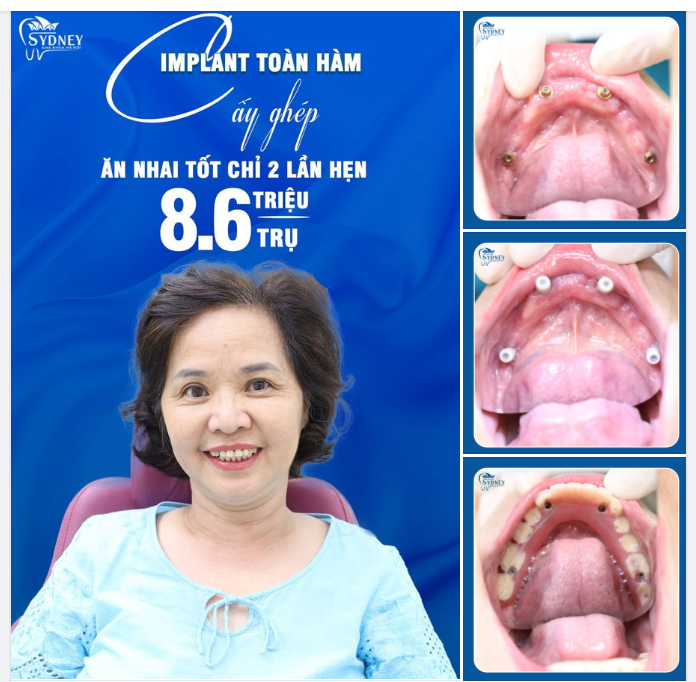 PHỤC HỒI RĂNG ĐÃ MẤT ĂN NHAI TRỌN ĐỜI