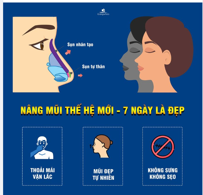 NÂNG MŨI CÔNG NGHỆ MỚI - 7 NGÀY LÀ ĐẸP