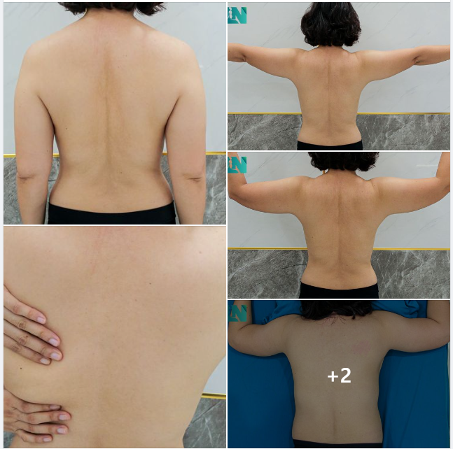 HÚT MỠ TẠO DÁNG THẨM MỸ TAY VÙNG CÁNH TAY, LƯNG, NÁCH CHO CHỊ KH 7X: TIN TƯỞNG GIẢM MỠ AN TOÀN TẠI EKIP CHUYÊN SÂU. TRỰC TIẾP 15H00 HÔM NAY.