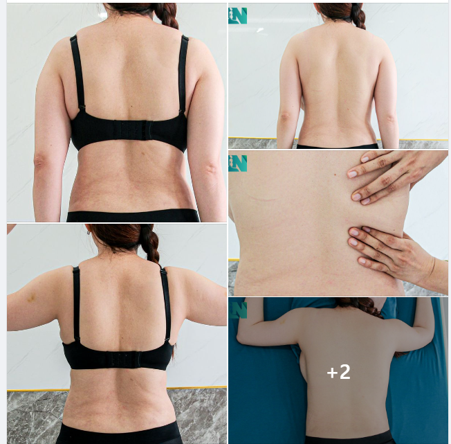 ĐỢT 2: HÚT MỠ TẠO DÁNG THẨM MỸ VÙNG CÁNH TAY, LƯNG, NÁCH CHO CHỊ KH ĐÃ HÚT MỠ BỤNG TẠI EKIP 2 NĂM TRƯỚC. TRỰC TIẾP 15H00 HÔM NAY.