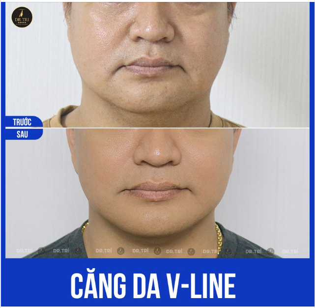 KHÁCH NAM TRẺ HƠN 10 TUỔI NHỜ CĂNG DA VLINE!